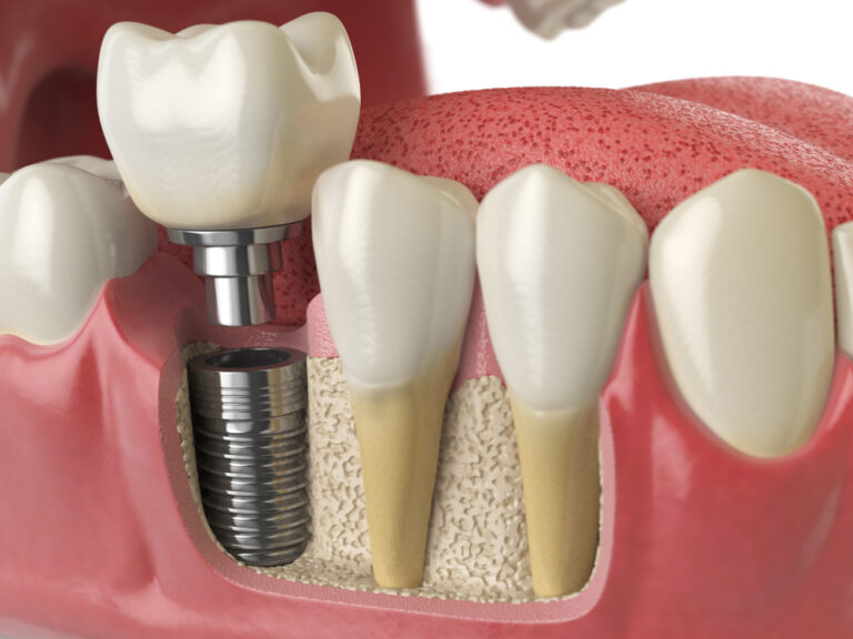 dental-implant-kent