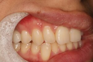 dental-implant-wye-kent