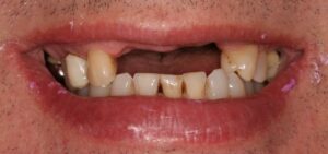 multiple-dental-implant-kent