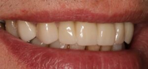 multiple-dental-implant-wye